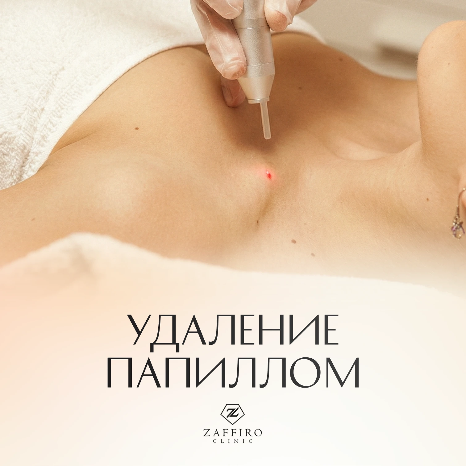 Zaffiro Clinic: Удаление папиллом